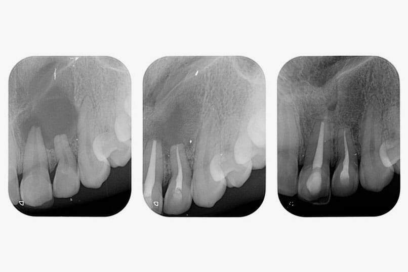 Endodonzia cura canalare Breganze