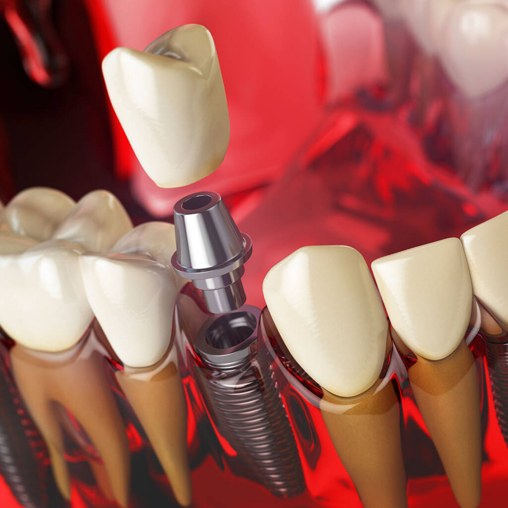 Implantologia Studio Dentistico Breganze